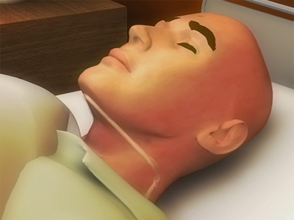 NorMors Kinnstütze 10 Stück